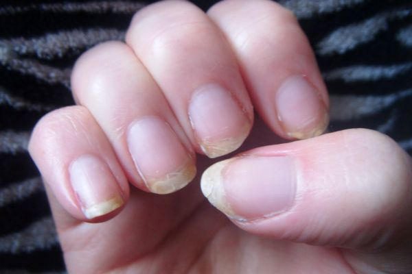   طول الاظافر يؤثر على الصحه	 Brittle-nails-1132x670