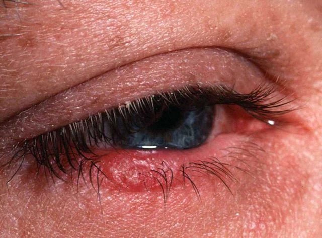 أسباب وأعراض جفاف العين والمضاعفات الناتجة عنه