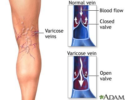 تمدد الأوعية الدموية في الساق